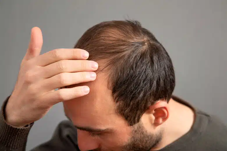Tratamiento capilar - Mesoterapia capilar - Eternal Hair Clinic Barcelona - 01