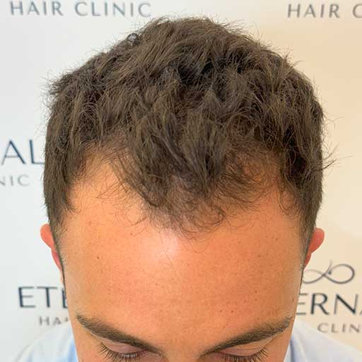 Alopecia en zona frontal antes del injerto capilar FUE Zafiro – Robert