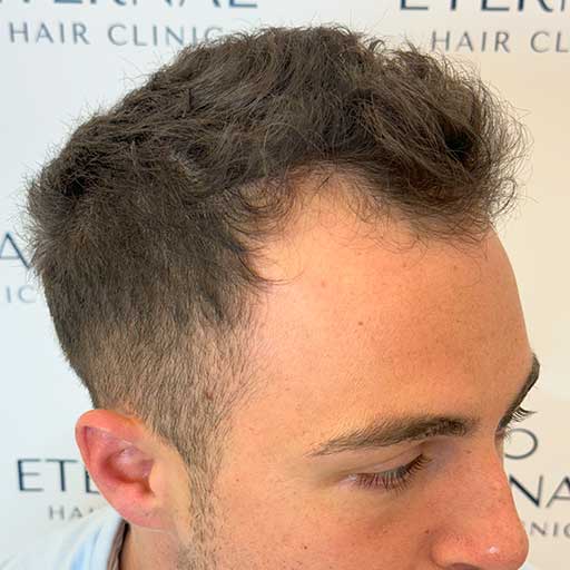 Alopecia androgenética en perfil derecho antes del injerto capilar – Robert