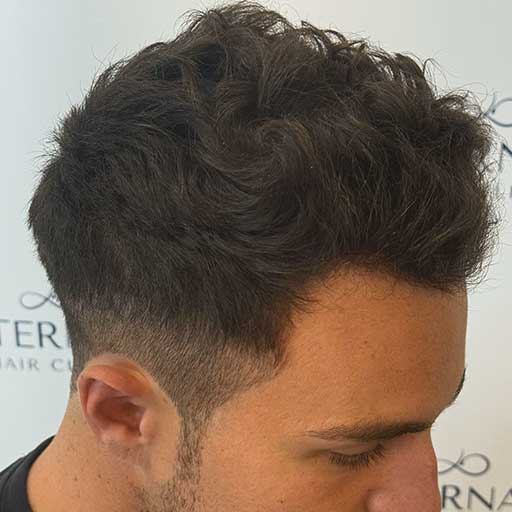 Resultado injerto capilar FUE Zafiro en perfil derecho, 6 meses después – Eternal Hair Clinic