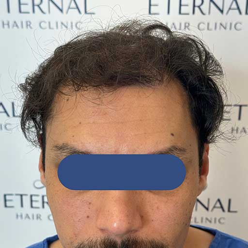 Zona frontal de Imad antes del injerto capilar – alopecia NW V