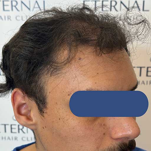 Perfil derecho de Imad antes del injerto capilar – alopecia avanzada NW V