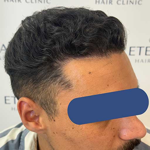 Perfil derecho de Imad tras injerto capilar FUE Zafiro – resultado a 7 meses