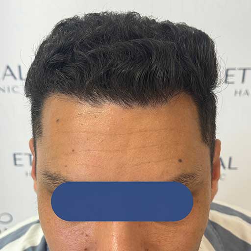 Resultado a los 7 meses tras injerto capilar FUE Zafiro en zona frontal – Imad