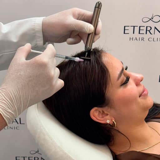 Tratamiento capilar con Mesoterapia y PRP capilar en Eternal Hair Clinic