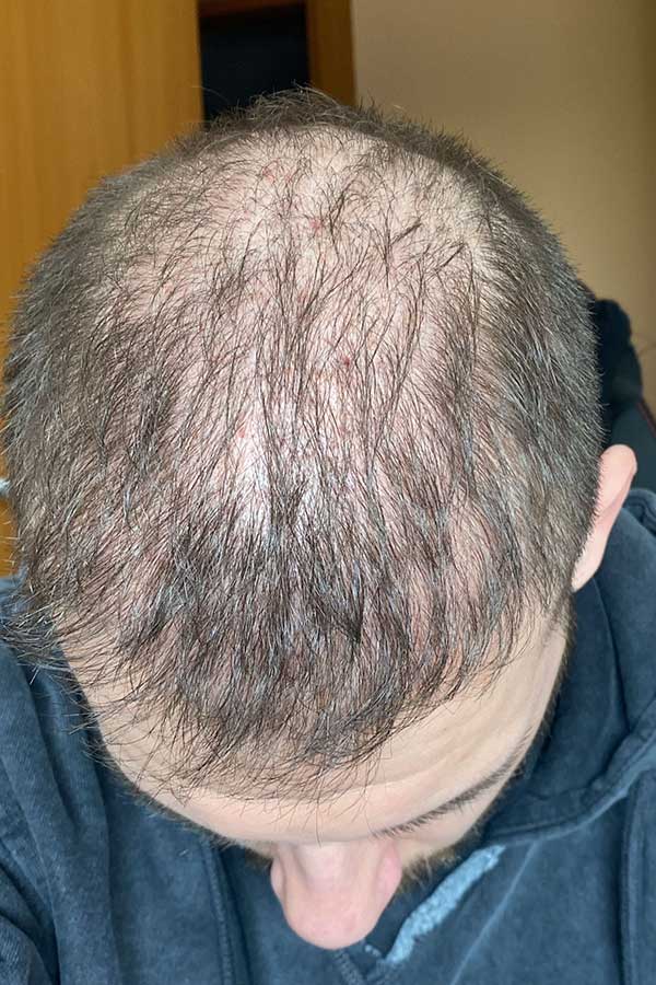 Antes de injerto capilar FUE Zafiro en Barcelona, vista superior con alopecia androgenetica y baja densidad en zona frontal y coronilla