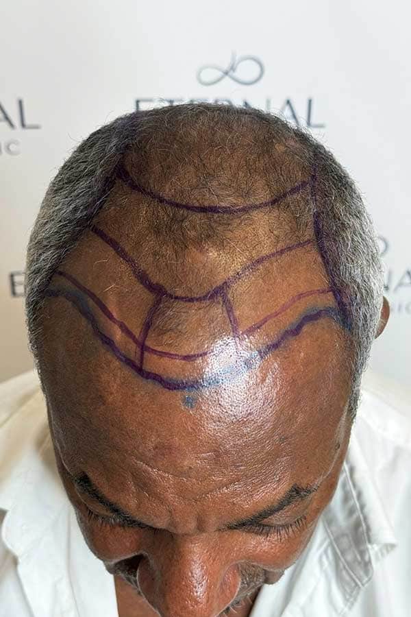 Antes de injerto capilar FUE Zafiro en Barcelona, paciente con alopecia avanzada y diseño preoperatorio de linea frontal