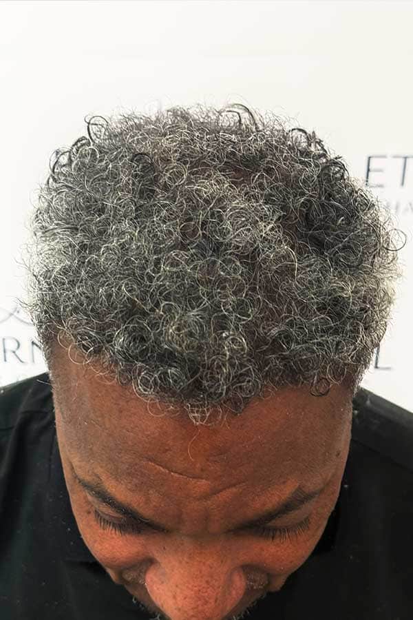 Despues de injerto capilar FUE Zafiro en Barcelona con restauracion de linea frontal y aumento significativo de densidad