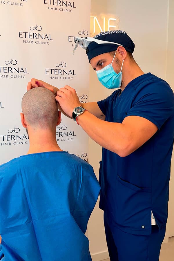 Cirujano capilar realizando diseño de linea frontal previo al injerto capilar en Barcelona