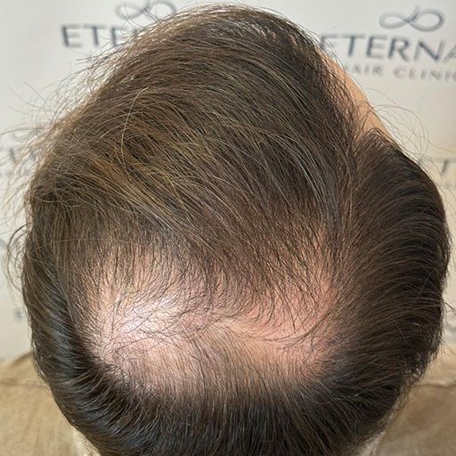 mario---antes---tratamiento-capilar---eternal-hair-clinic